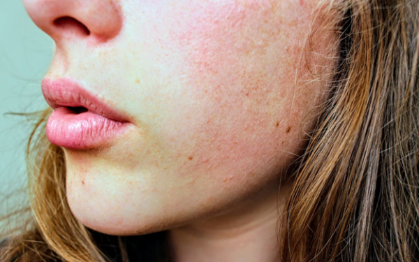 what not to do when you have rosacea