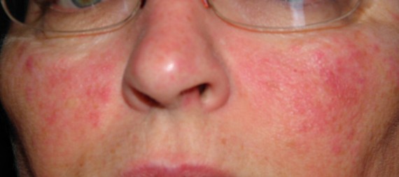 rosacea, lupus, facial rash
